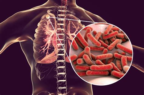 Mysterious U S Outbreak Of Bone Eating Tuberculosis Resembled An
