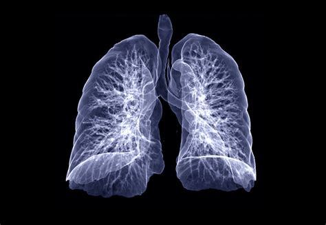Covid 19 Can Cause Lasting Lung Damage 3 Ways Long Covid Patients