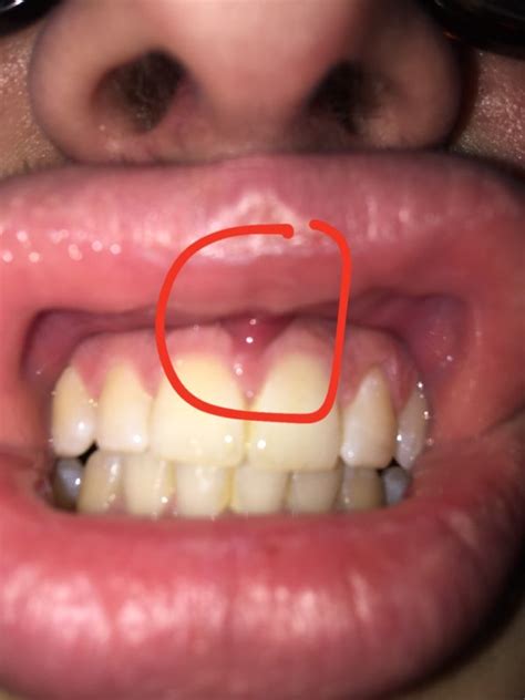 What Is This Painful Bump On My Gum Should I See A Dentist Or Doctor