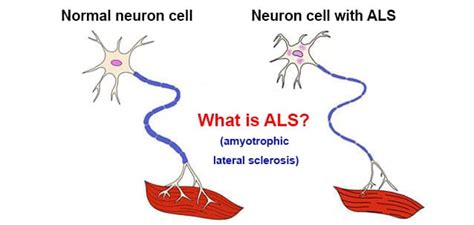 What is amyotrophic lateral sclerosis? What is ALS? Causes, symptoms, treatment and recommendations