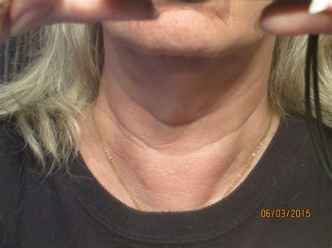 Thyroidectomy My Experience Hubpages