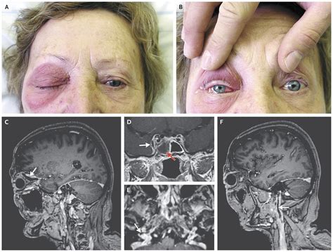 Septic Cerebral Venous Thrombosis Nejm