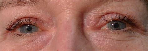 Eyelid Surgery Blepharoplasty Blepharoptosis City Eye Specialists