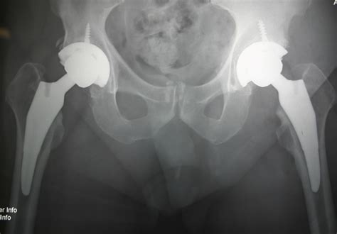 Problems With Total Hip Replacement Uk Hip Pain From Sleeping On Your