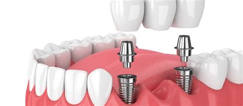 What Are The Benefits Of Mini Dental Implants Lompoc Oms