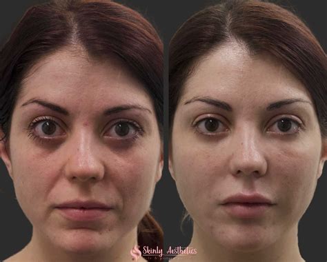 Smile Line Fillers Before And After Results At Skinly