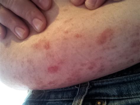 Itchy Rash On Stomach Belly Button Rash Treatment Causes Pictures