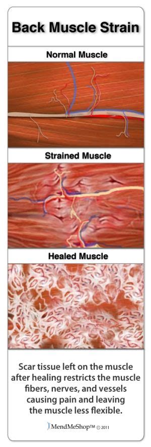 Pin On Back Muscle Strain Treatment