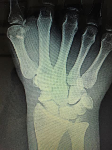Scaphoid Fracture Hand Orthobullets