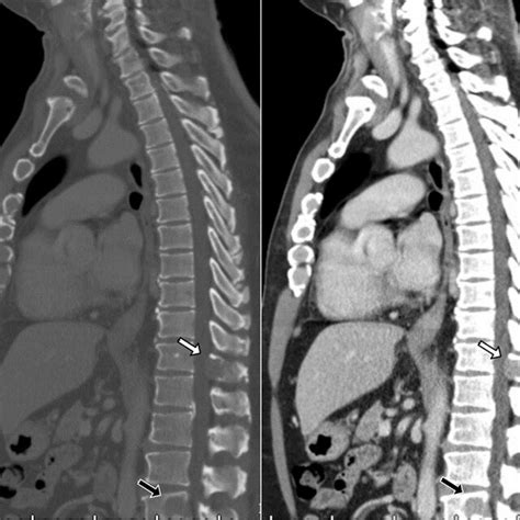 Sagittal Ct Images Demonstrating Osteolytic Lesions With Adjacent Soft