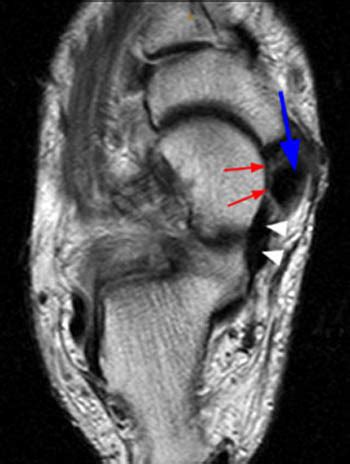 Spring Ligament Tear - Radsource