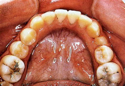 Hydrogen peroxide is an oxidizer that stimulates the enamel to loosen up the coffee particles and baking soda stimulates the reaction. Black Spots On Teeth But No Cavities - TeethWalls