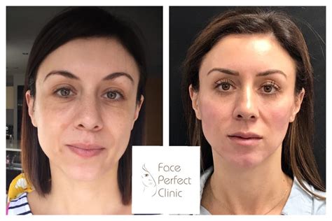 Face Contouring In Leeds Dermal Fillers Face Perfect Clinic