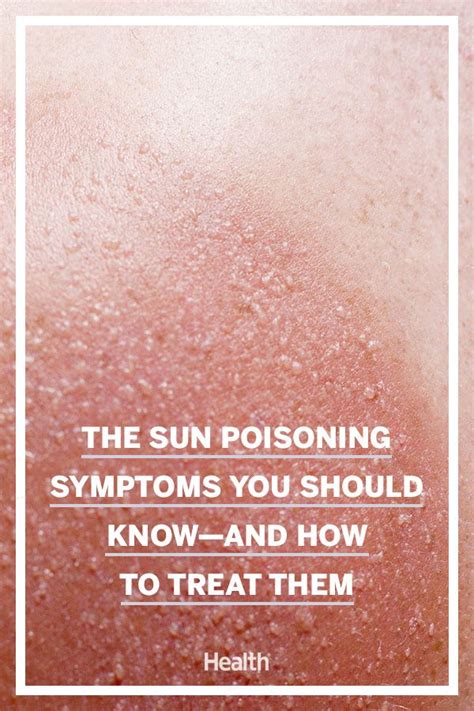 The Sun Poisoning Symptoms You Should Know—and How To Treat Them Sun