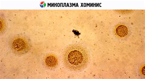 Mycoplasma Hominis En Mujeres Hombres Y Niños Síntomas Tratamiento