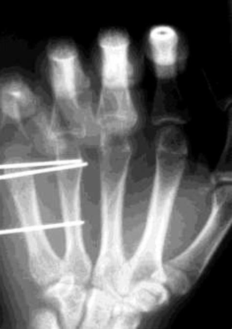 Surgical Fixation Of Metacarpal Fractures Musculoskeletal Key