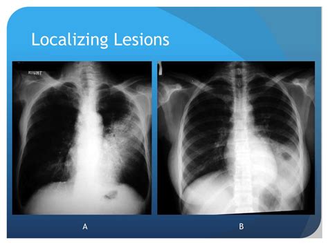 Ppt Chest X Ray Interpretation For The Internist Powerpoint