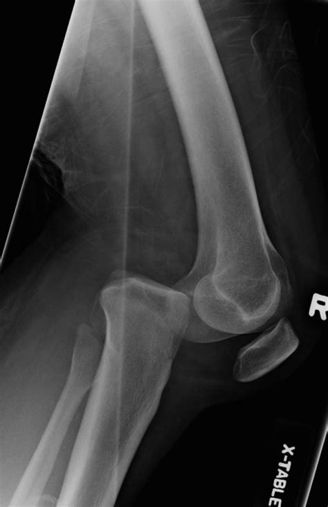 Anatomy Of The Knee Cap