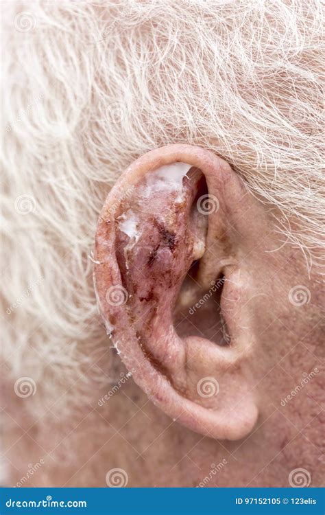Ear Wound Stock Image Image Of Human Stitching Space 97152105