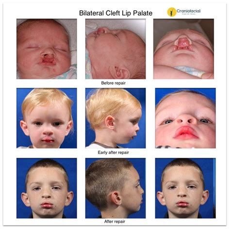 Cleft Lip And Palate Gallery Dell Childrens Craniofacial Team Of Texas