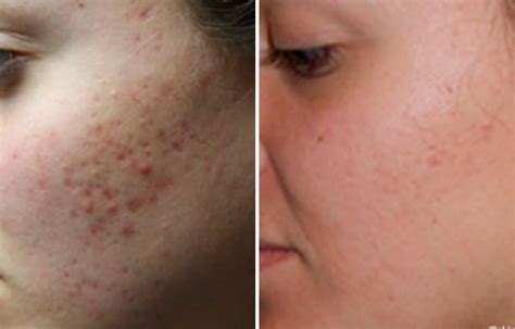 How To Banish Acne Scars Best Acne Scar Treatment Holistic Meaning