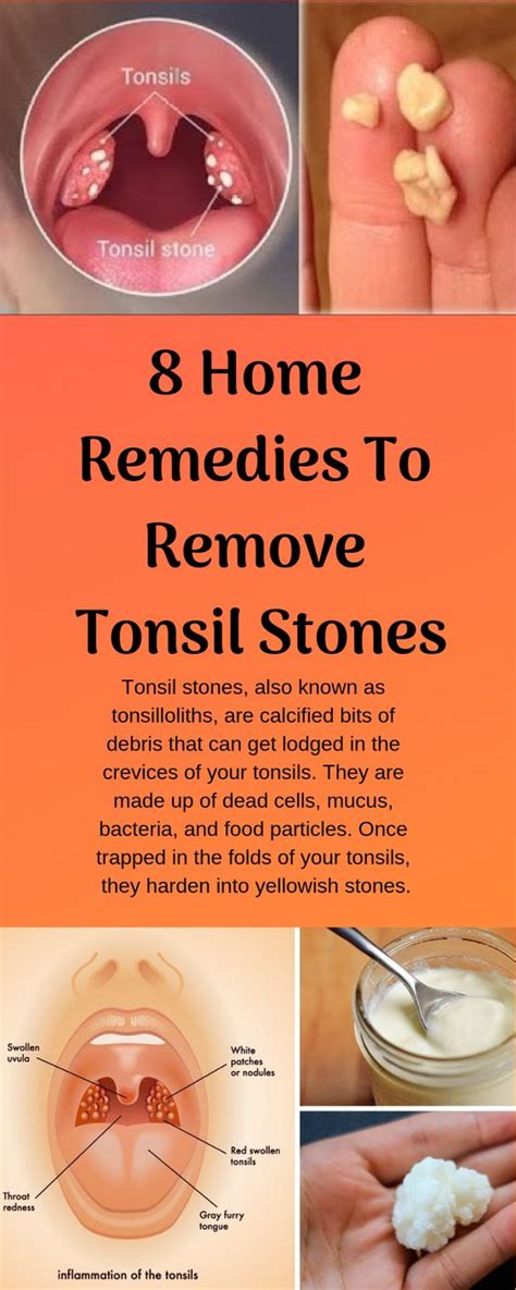 How To Remove Tonsil Stones With Cotton Swab Howotremvo