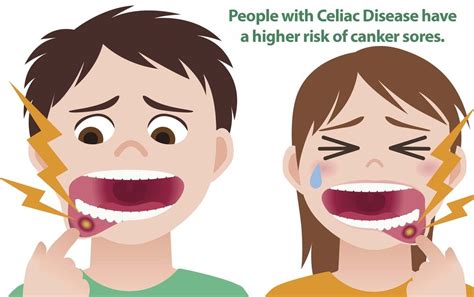 People With Celiac Disease Have A Higher Risk Of Canker Sores