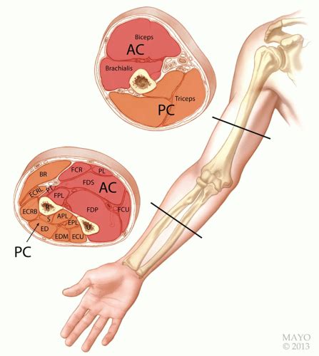 Surgical Decompression Of Acute Compartment Syndrome Of The Arm And