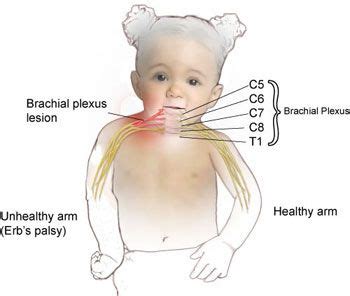 Erbs Palsy Is A Paralysis Of The Arm Upper Limb This Injury Is