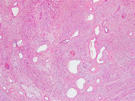 Pathology Outlines Cellular Angiofibroma