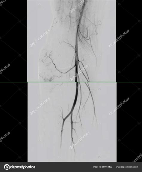 Femoral Angiogram Medical Procedure Used Visualize Blood Vessels Groin