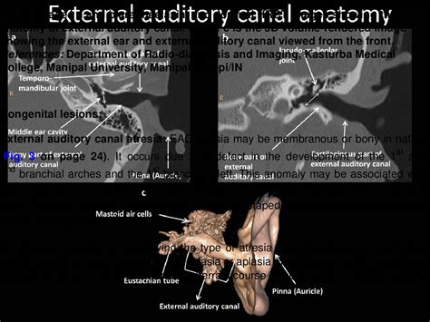 High Resolution CT Of External Ear And External Auditory Canal