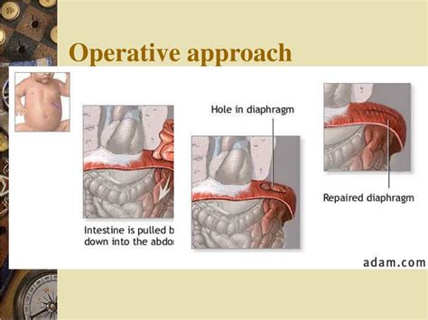 Ppt Diaphragm And Hiatus Hernia Powerpoint Presentation Free