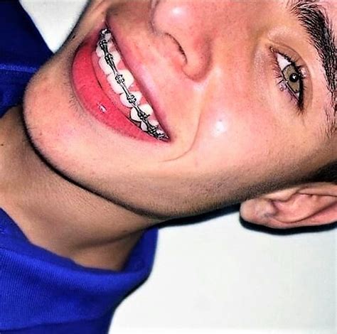Pin By Cameron Reynolds On Braces Guys With Braces Cute Braces