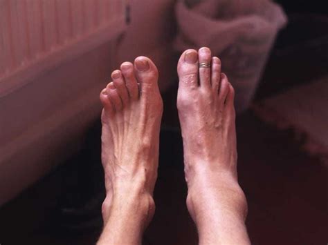 Causes Of Edema In Lower Legs And Feet Elderly Video Editor Zdarma What Can Cause Swelling In