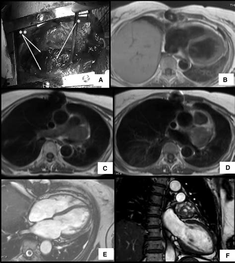 A Surgical Resection Of The Intrapericardial Thymoma View From A