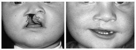 JCM Free Full Text Nasolabial Appearance In 5 Year Old Patients