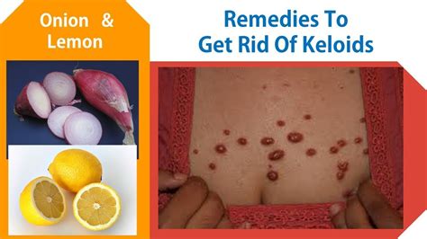 Home Remedies To Get Rid Of Keloids Onion And Fresh Lemon Juice Remedy