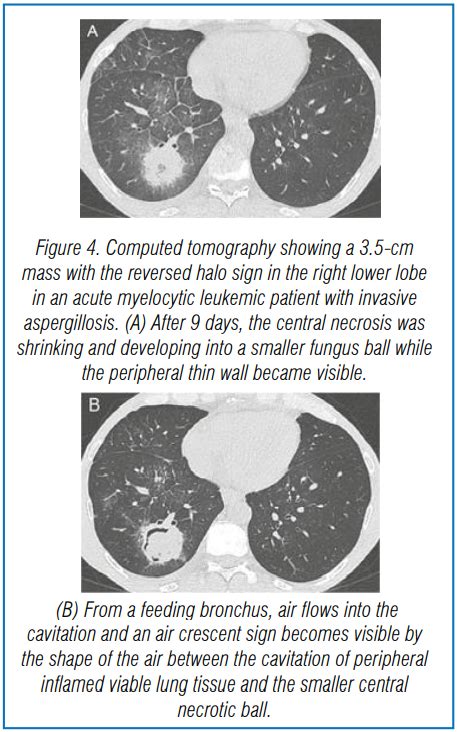 Guidance On Imaging For Invasive Pulmonary Aspergillosis And