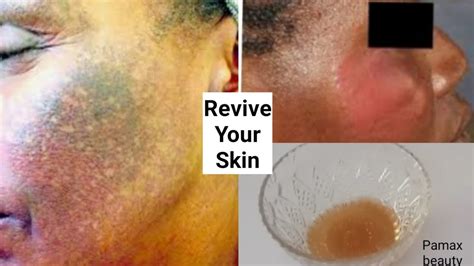 Get Rid Of Chemical Burns Dark Spots And Blemishes How To Get Rid Of