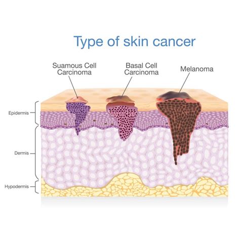 Bala Cynwyd Skin Cancer Treatment Melanoma And Basal Cell Carcinoma