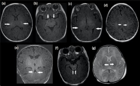Pediatric Mri Brain Normal Or Abnormal That Is The Question