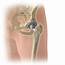 What To Expect During Hip Replacement Surgery