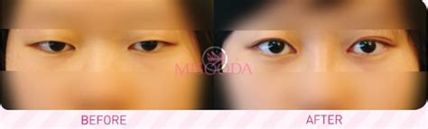 why korean ptosis correction eyelid surgery is different guide reviews promotions misooda