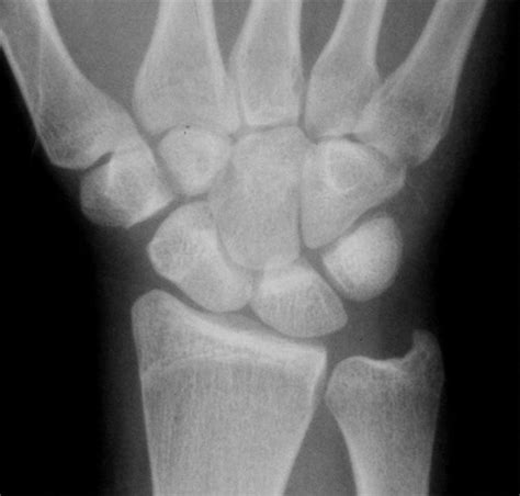 Traumatic Axial Dislocation Injuries Of The Wrist Radiology