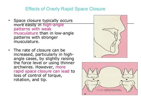 Retraction Mechanics