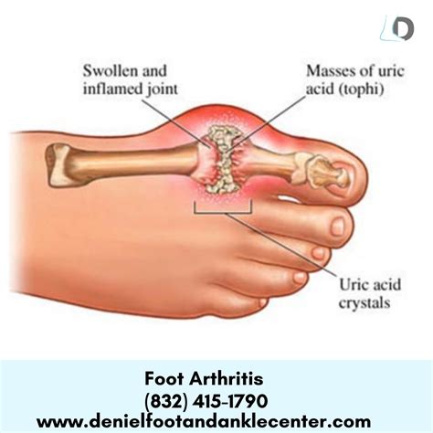 Foot Arthritis Can Be Very Uncomfortable To Live With If You Are Experiencing Arthritic Pain