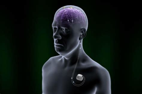 Fda Approves New Deep Brain Stimulation Device Parkinsons Disease