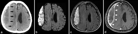 Helicobacter Cinaedi Infected Chronic Subdural Hematoma Mimicking An