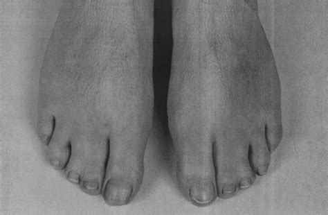 Feet Of Case A Iv4 Showing Broad And Short Distal Phalanges Of The